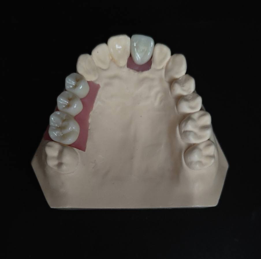Implant crowns and bridges
