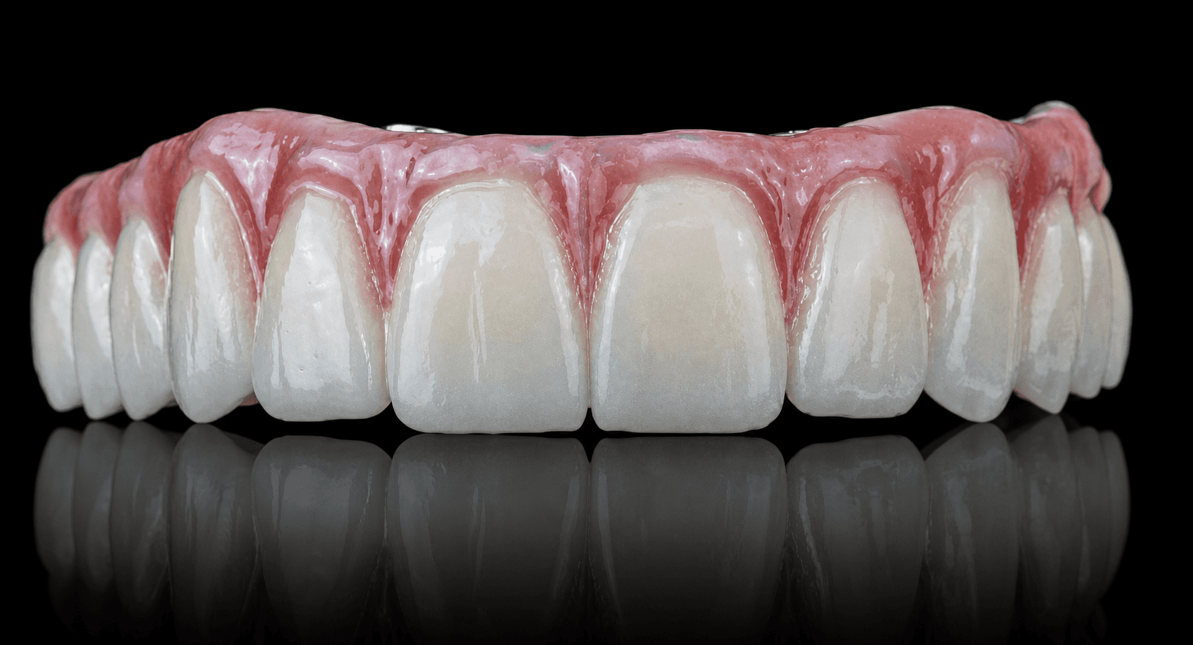 Full-Arch Implant Restoration