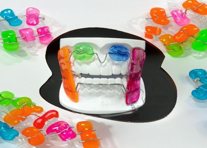 Revolutionary Orthodontic Treatment: Clear Braces with Colored Brackets