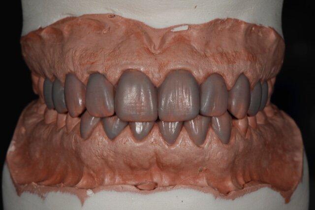 Lista de verificación para la prueba de cera de prótesis dentales completas: qué aprobar antes del procesamiento final