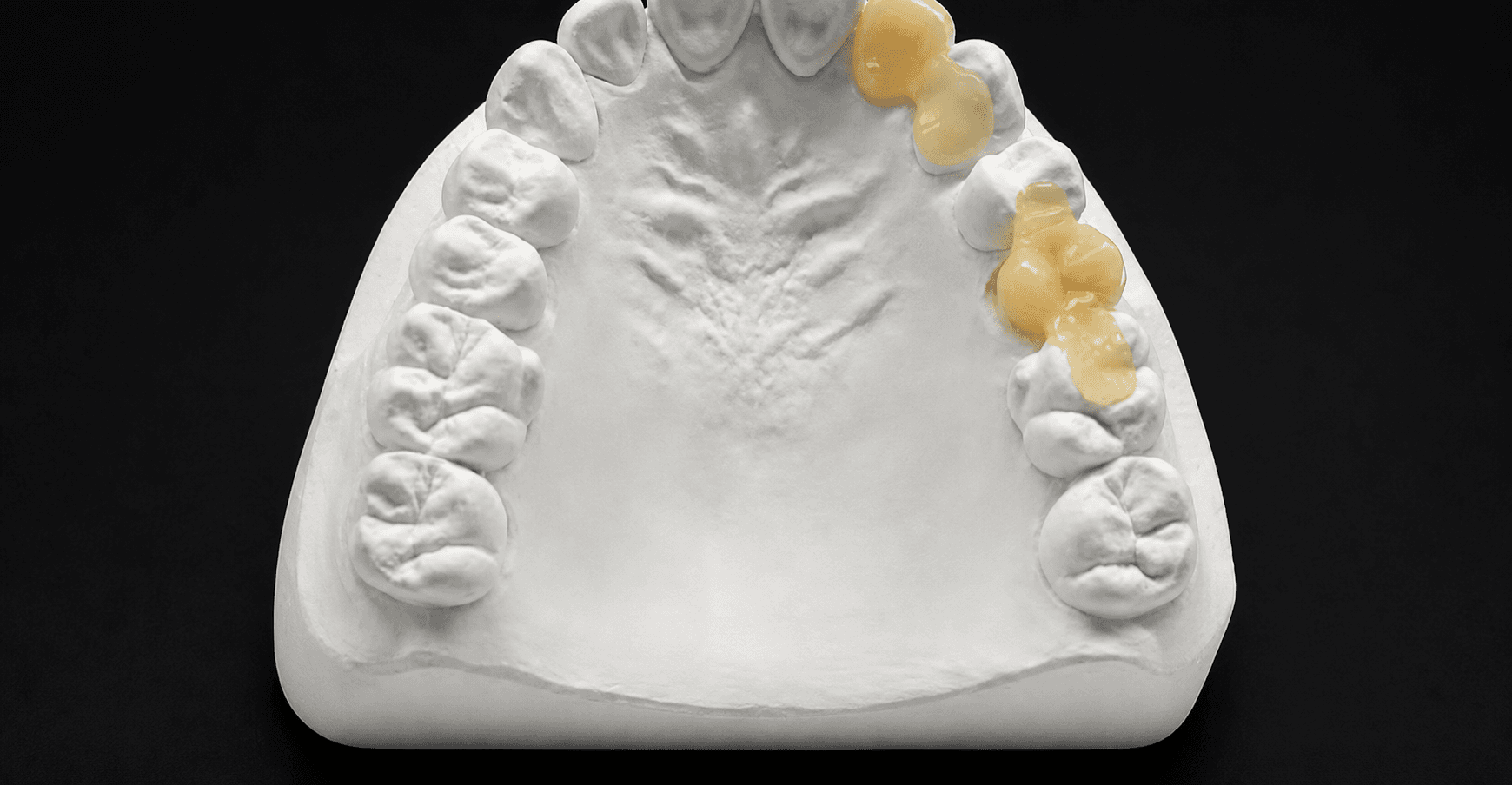 Guía de presentación de casos para puentes dentales en Maryland: Opciones de diseño y documentación que necesitan los laboratorios dentales.