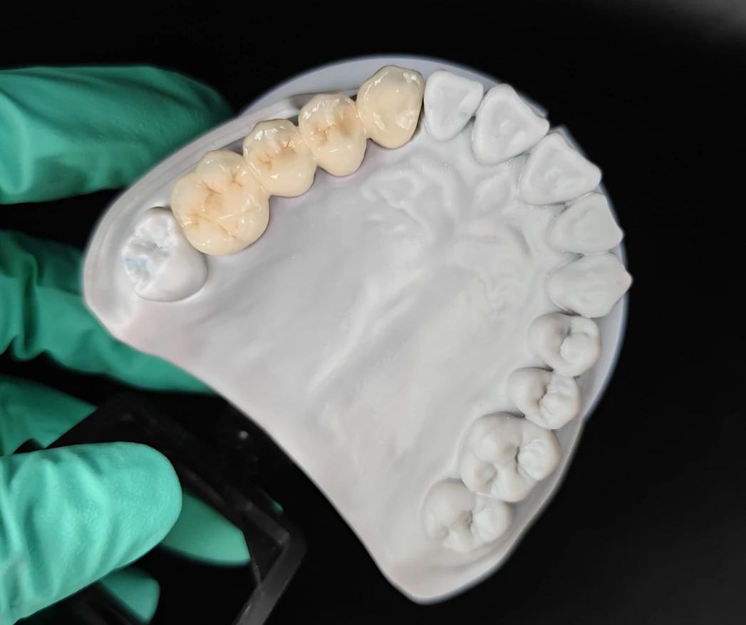 크라운과 브릿지