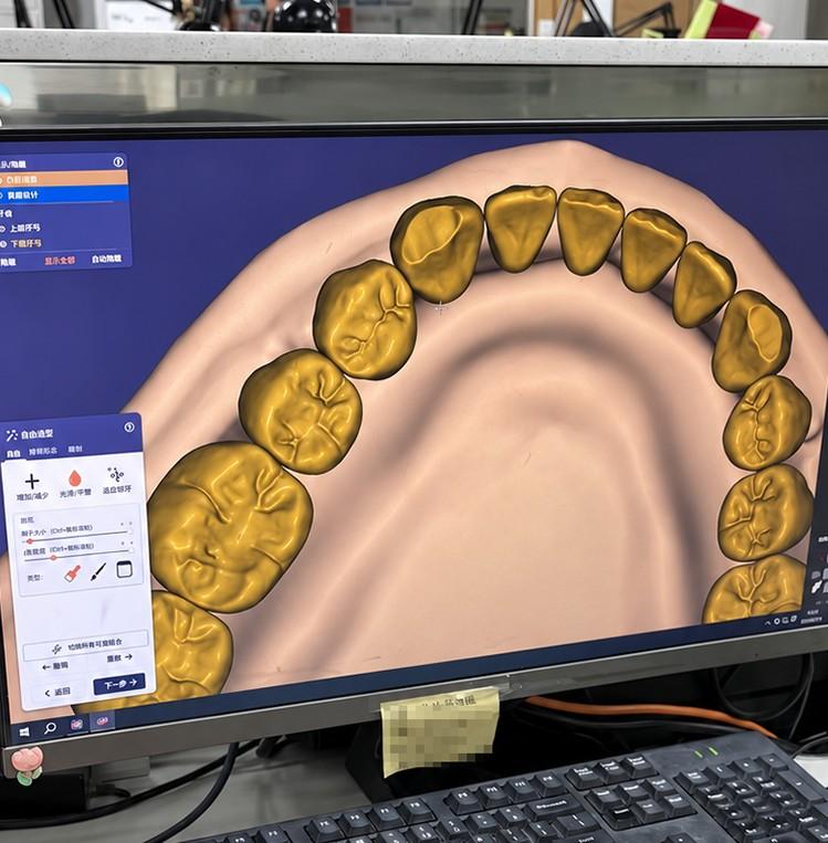 Digital denture tooth setup on a design workstation